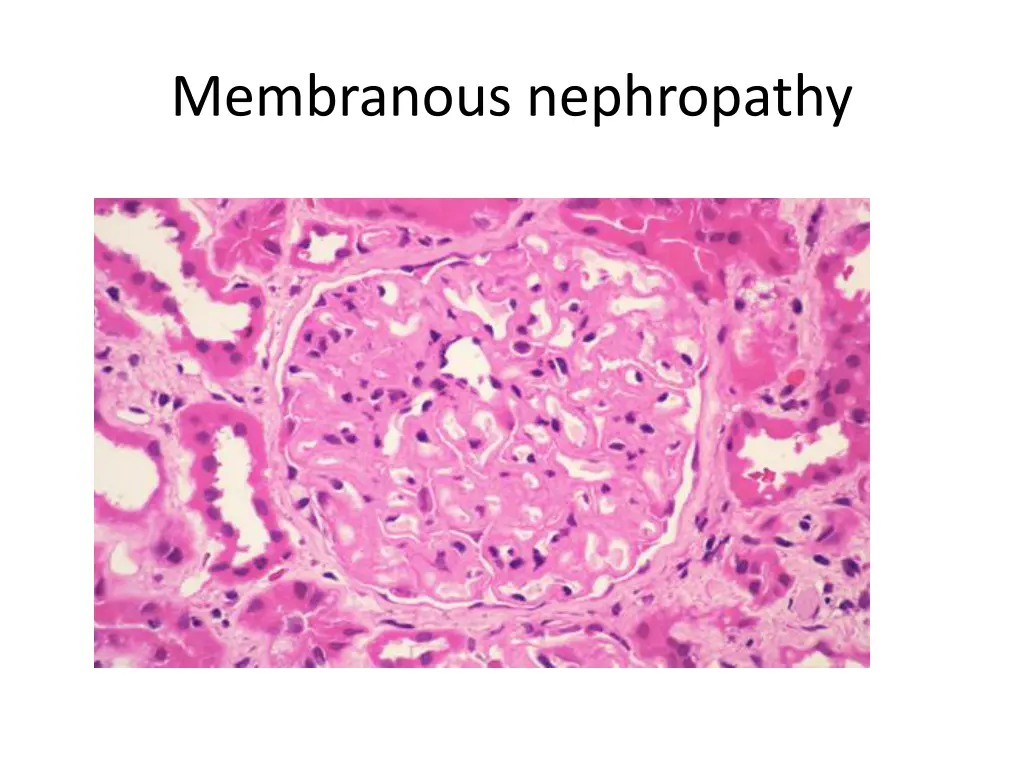 membranous nephropathy