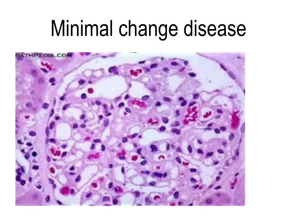 minimal change disease