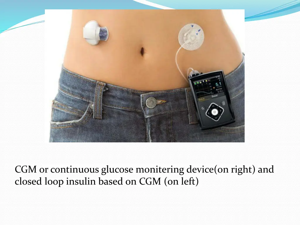 cgm or continuous glucose monitering device