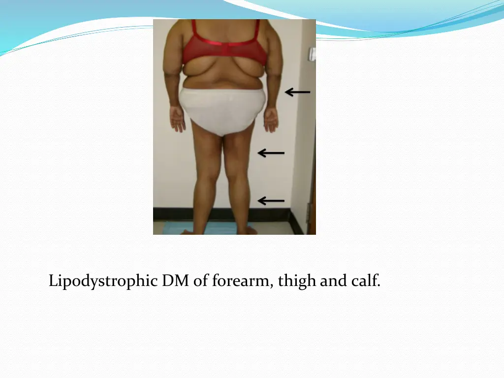 lipodystrophic dm of forearm thigh and calf