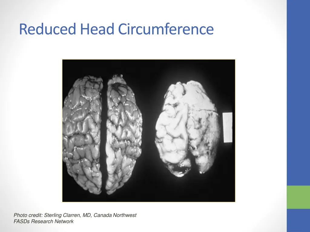 reduced head circumference