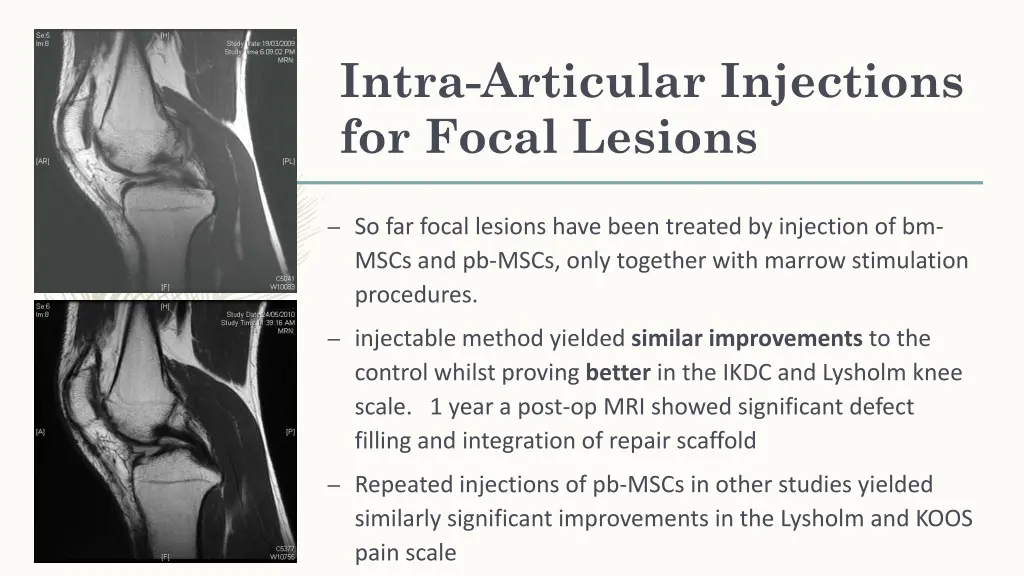 intra articular injections for focal lesions