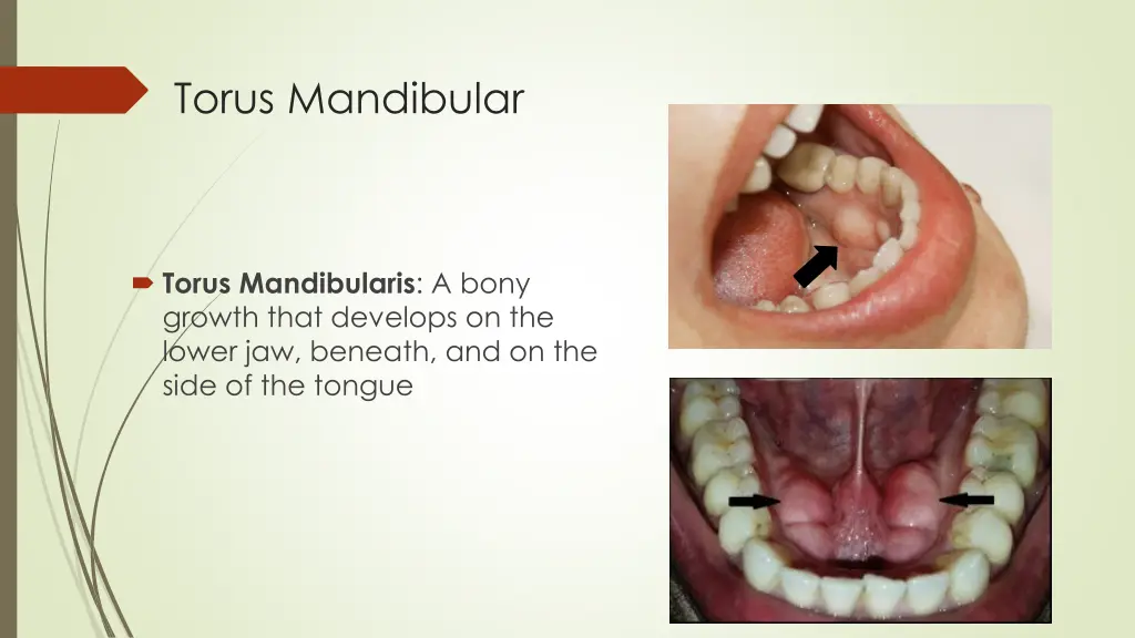 torus mandibular