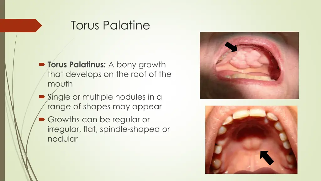 torus palatine