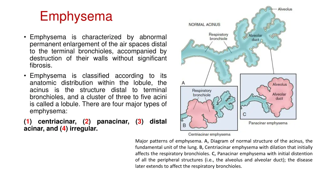 emphysema