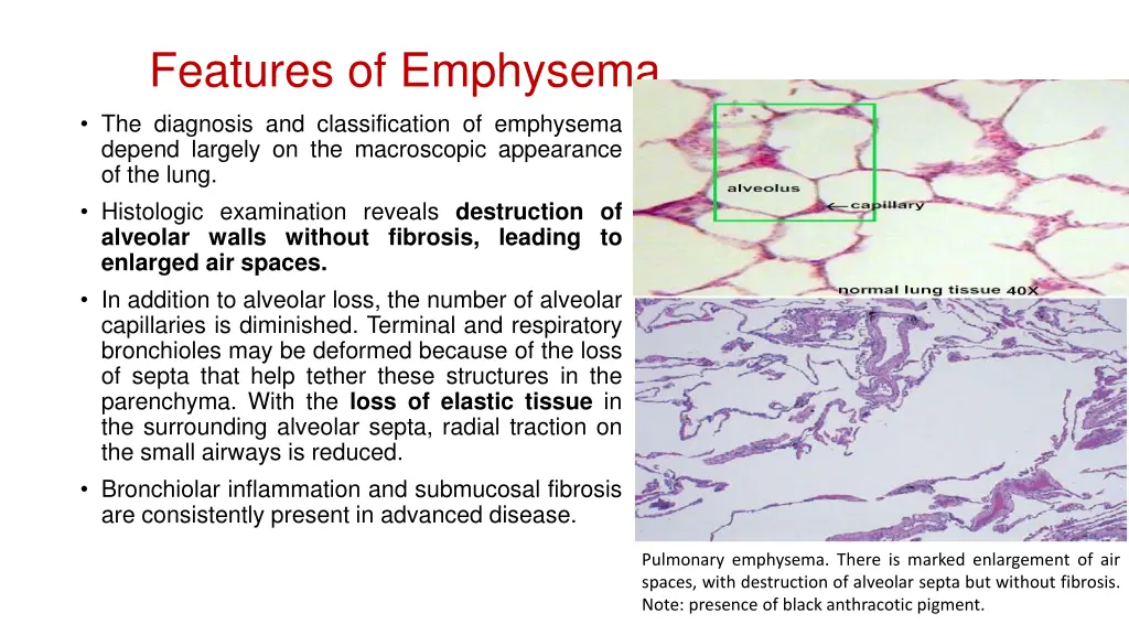 features of emphysema