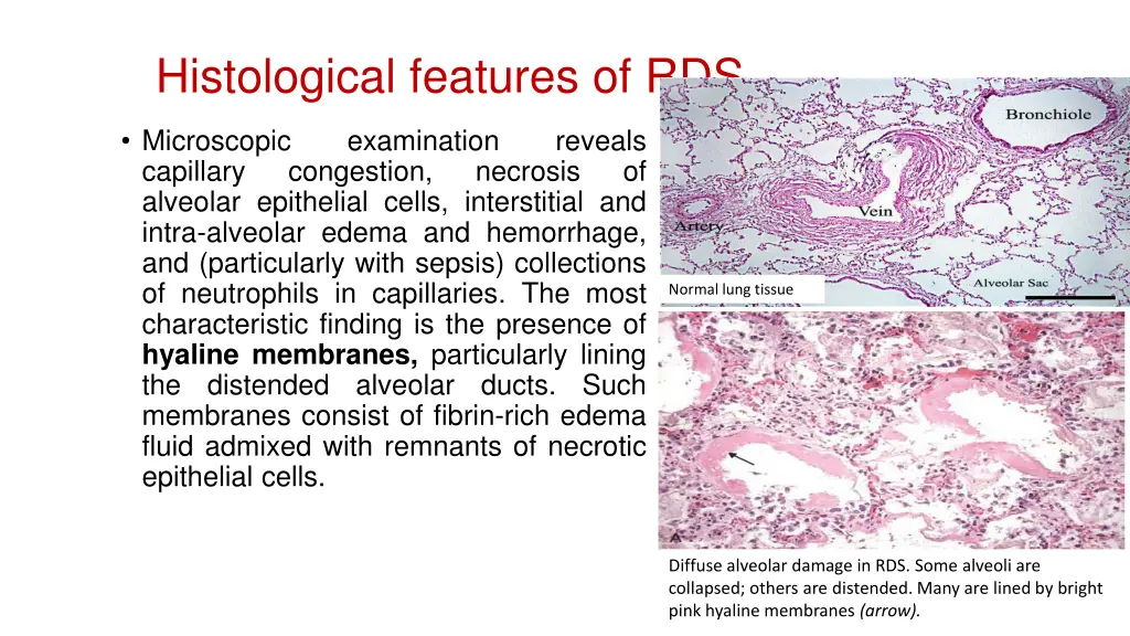 histological features of rds