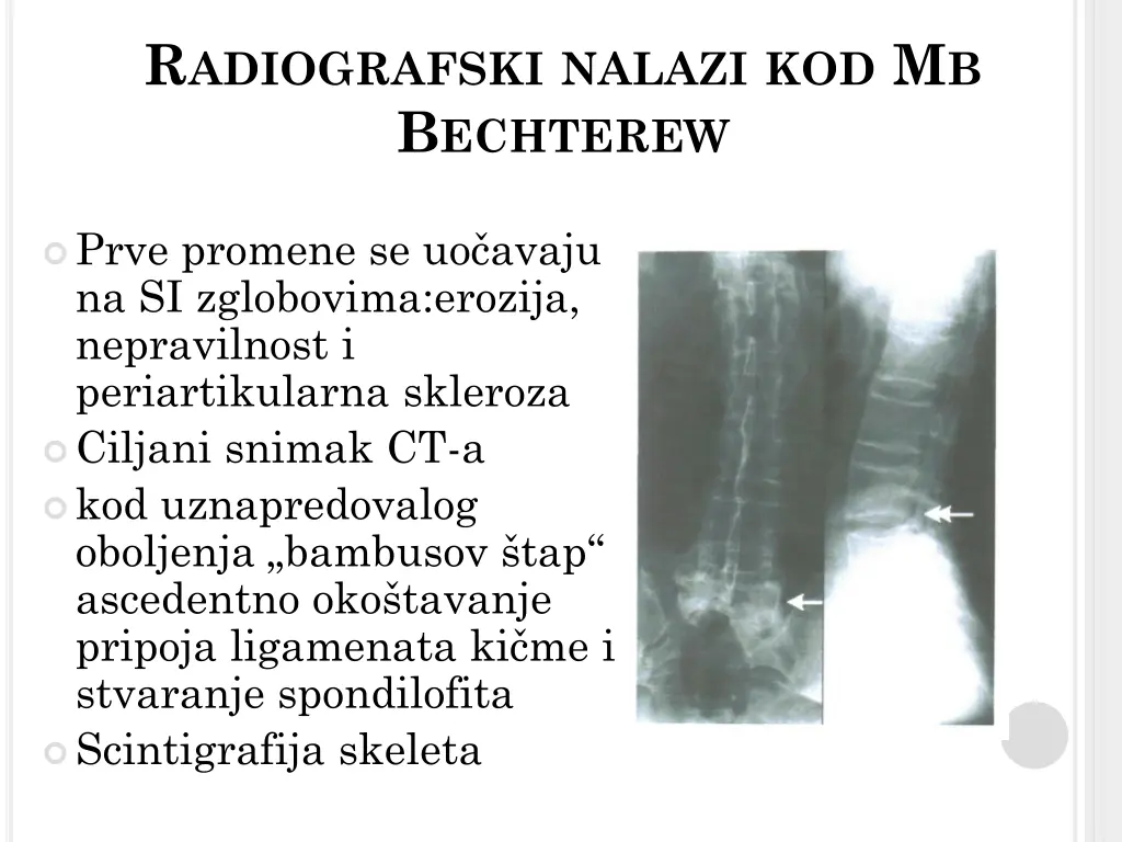 r adiografski nalazi kod m b b echterew