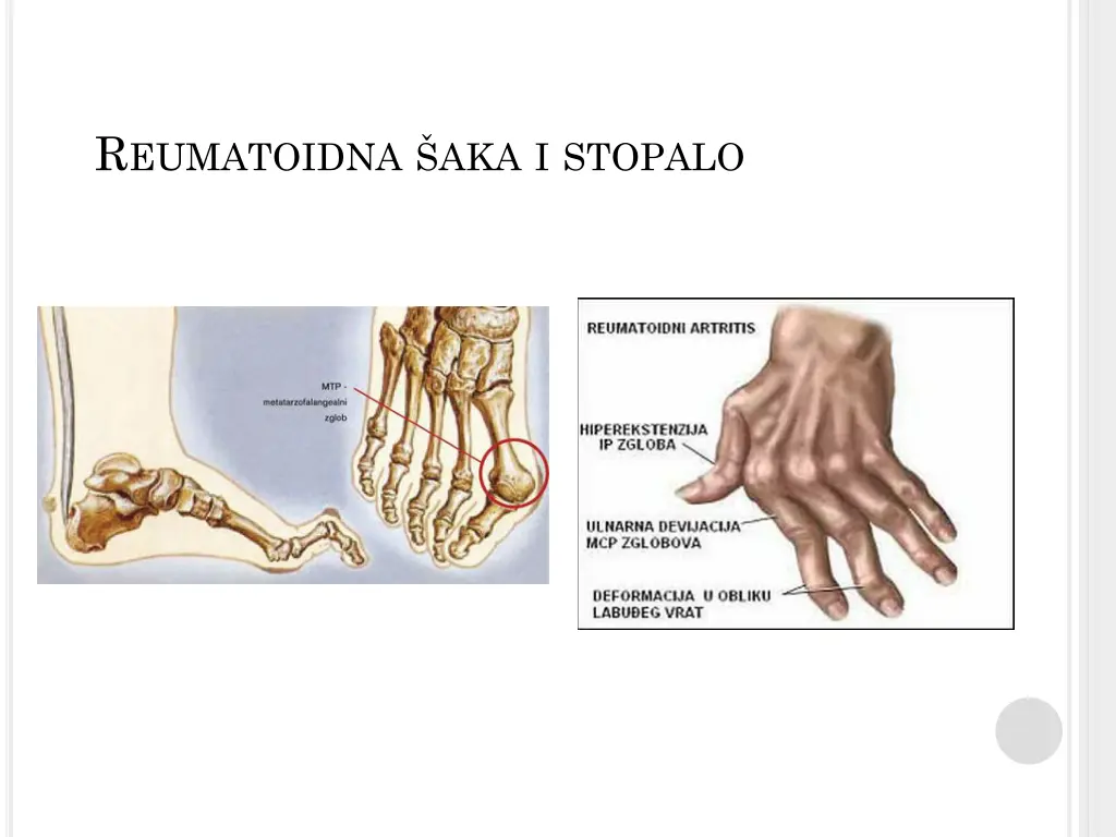 r eumatoidna aka i stopalo
