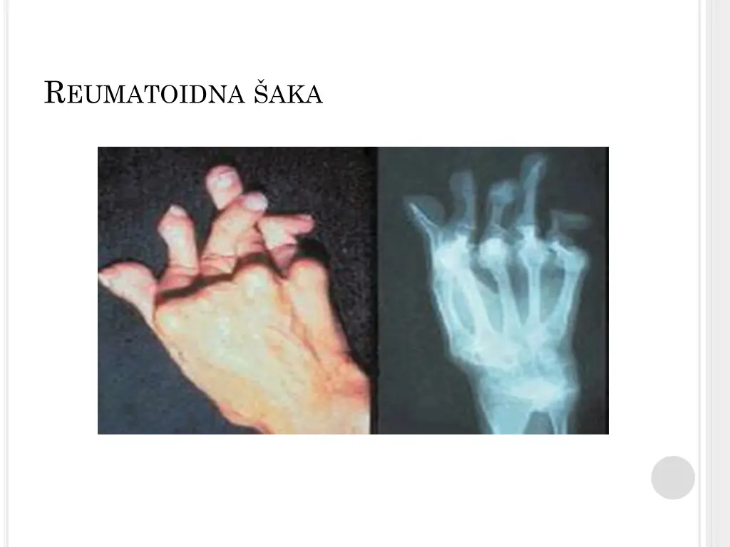 r eumatoidna aka