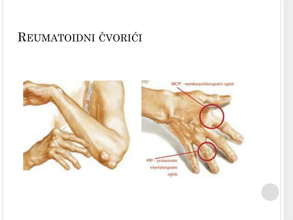 r eumatoidni v ori i