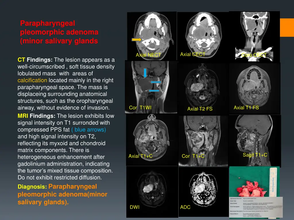 parapharyngeal pleomorphic adenoma minor salivary 1