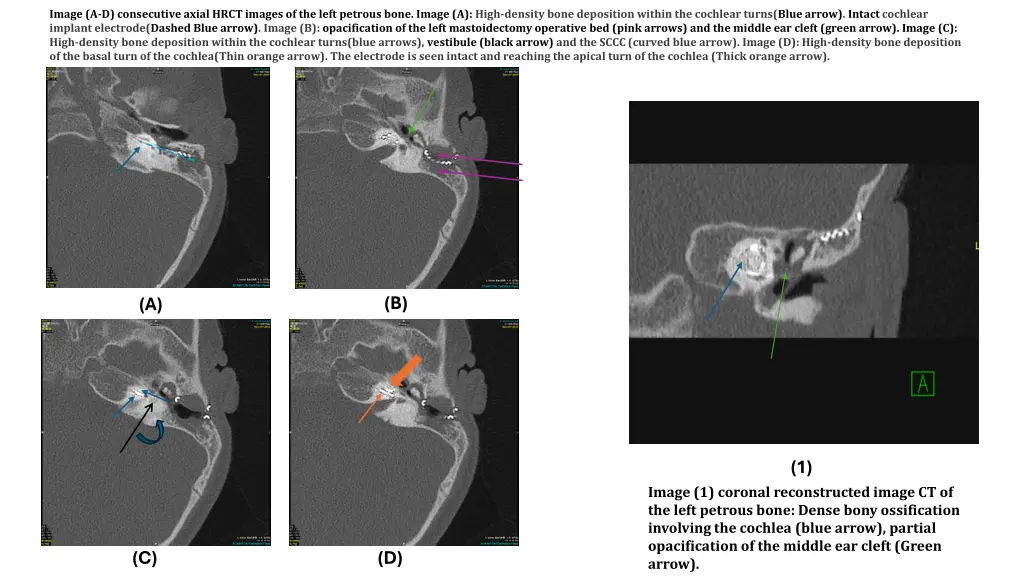 image a d consecutive axial hrct images