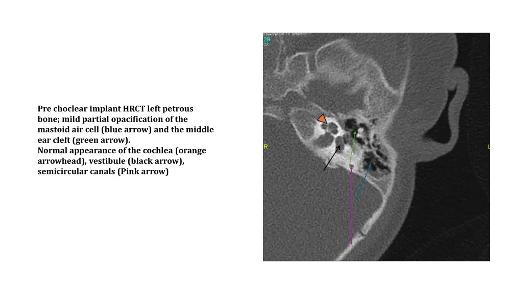 pre choclear implant hrct left petrous bone mild
