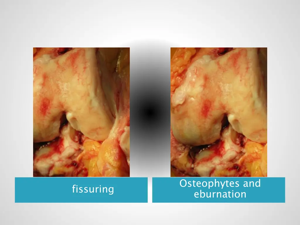 osteophytes and eburnation