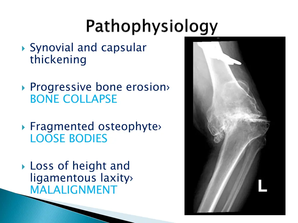 synovial and capsular thickening