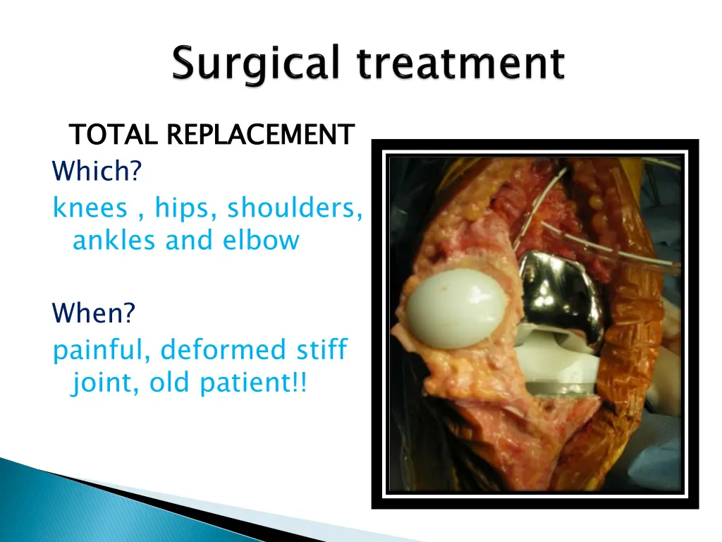 total replacement which knees hips shoulders