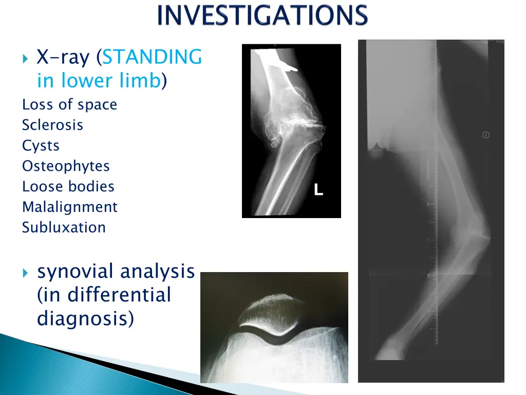 x ray standing in lower limb loss of space