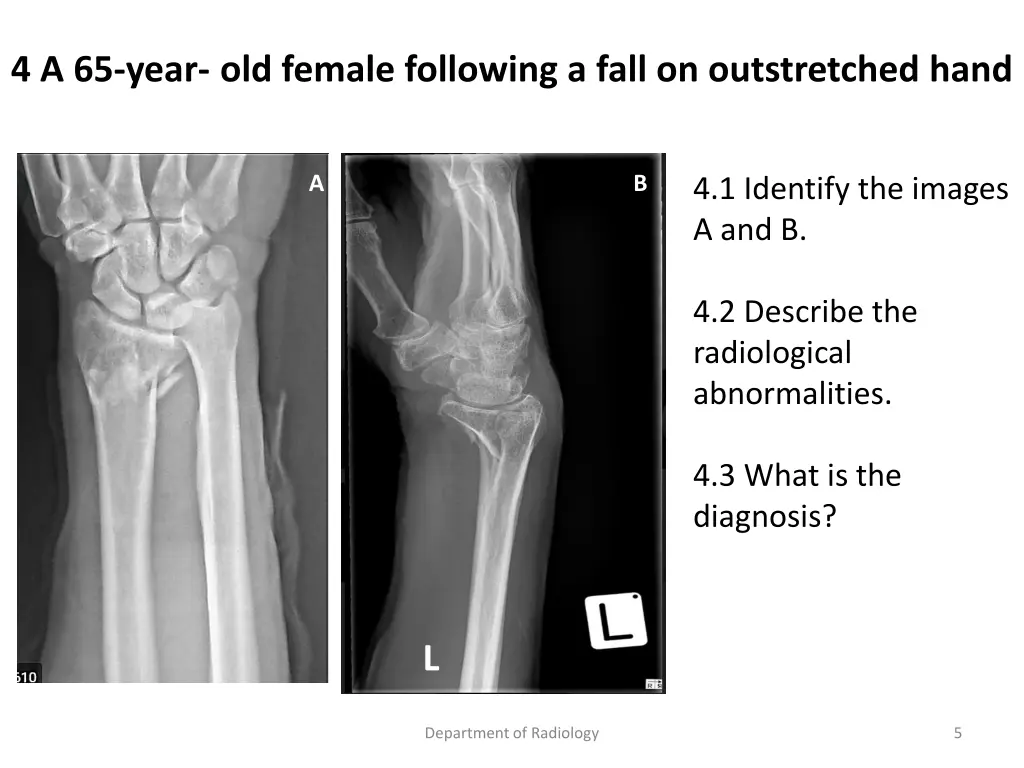 4 a 65 year old female following a fall
