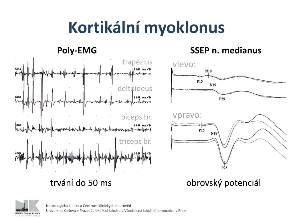 kortik ln myoklonus 1
