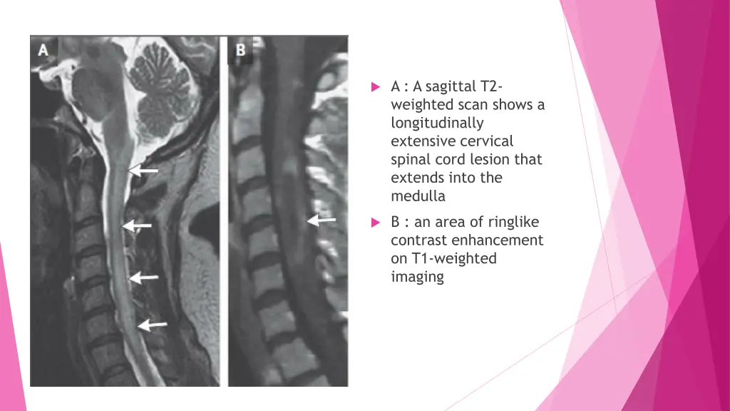 a a sagittal t2 weighted scan shows
