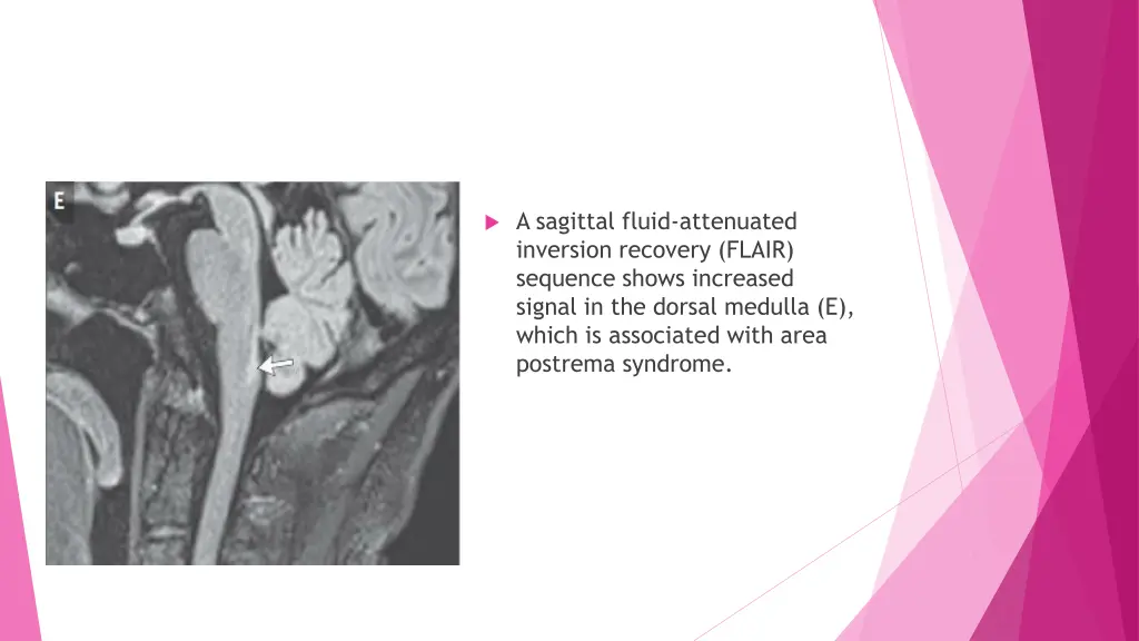 a sagittal fluid attenuated inversion recovery