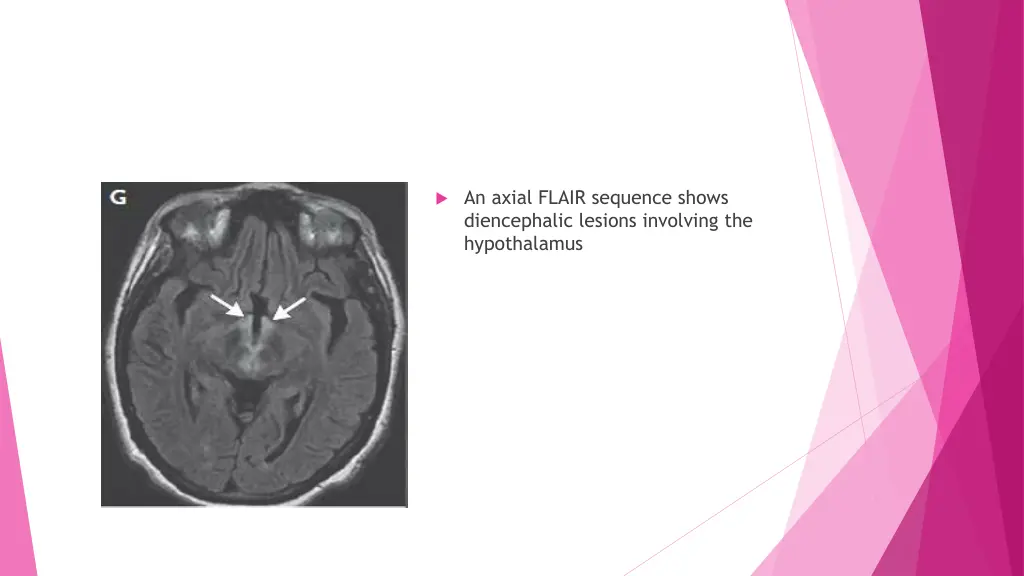 an axial flair sequence shows diencephalic