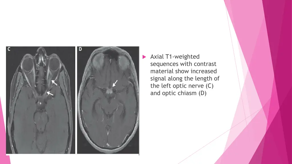 axial t1 weighted sequences with contrast