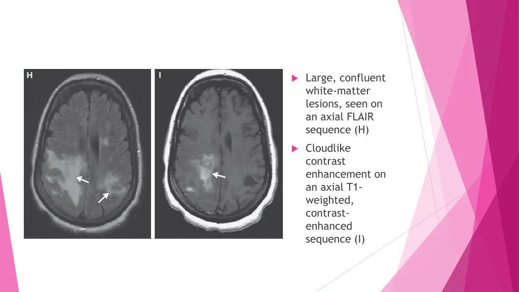 large confluent white matter lesions seen