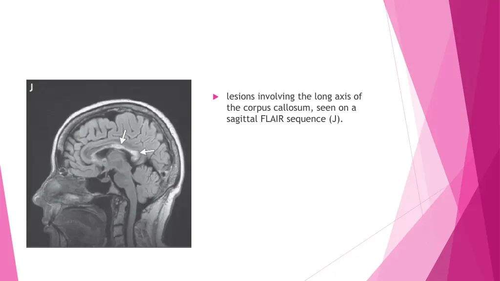 lesions involving the long axis of the corpus