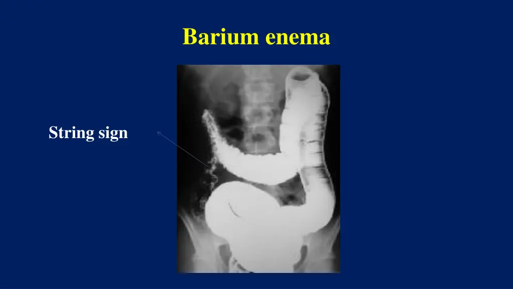 barium enema 2