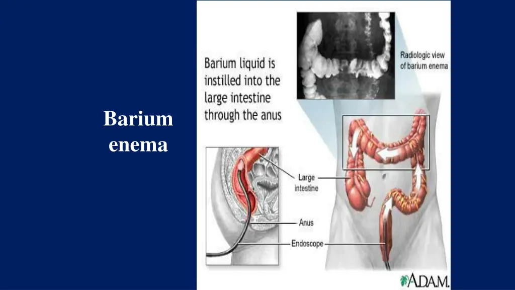 barium enema