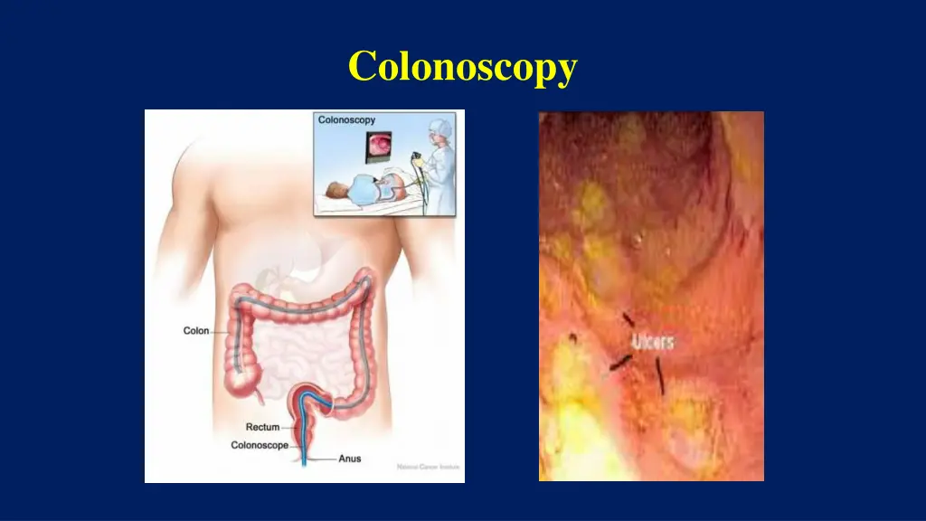 colonoscopy