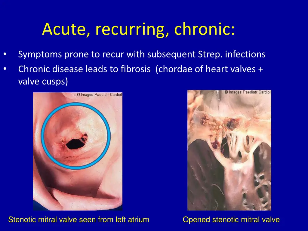 acute recurring chronic