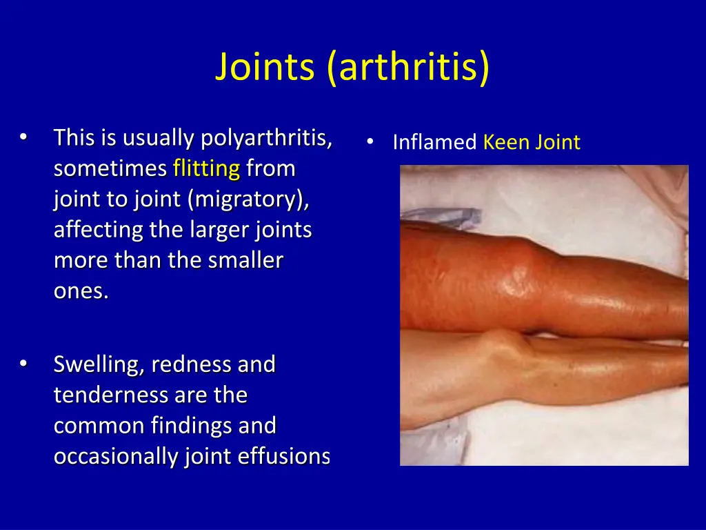joints arthritis