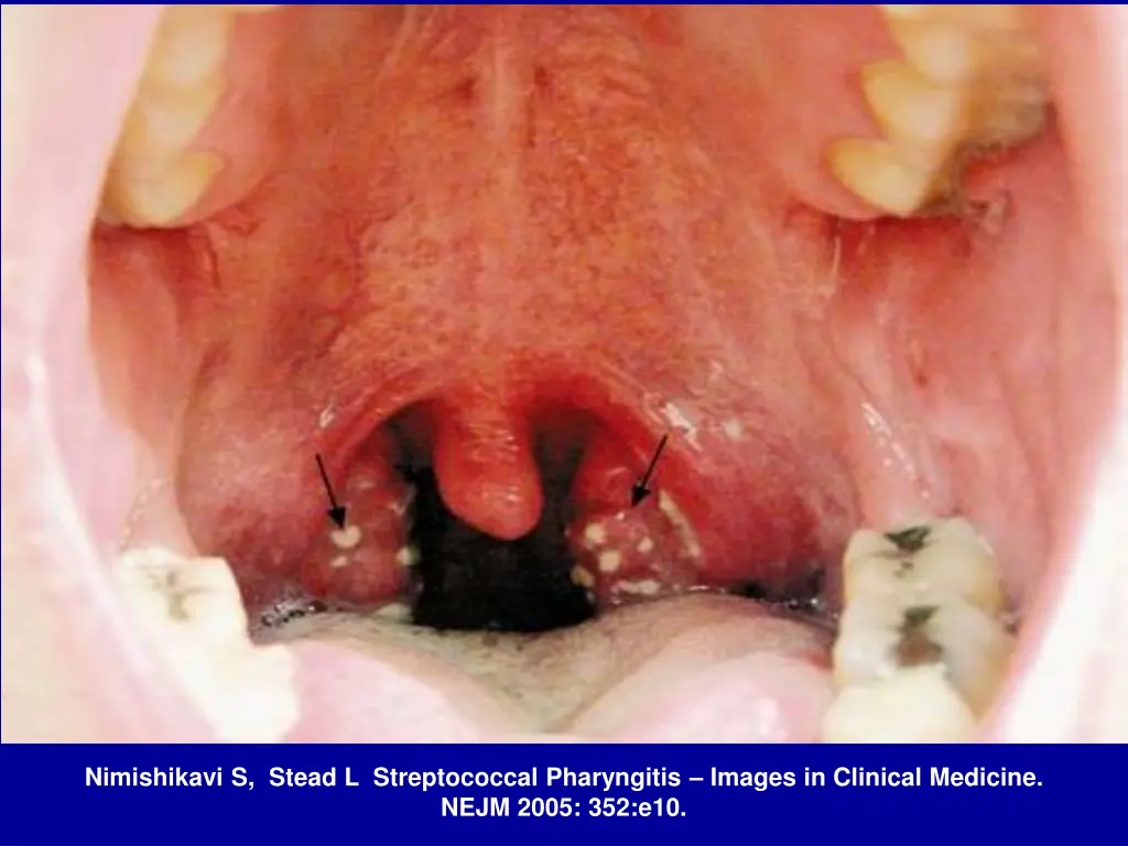 nimishikavi s stead l streptococcal pharyngitis