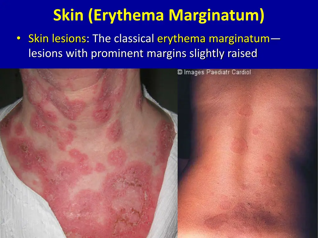 skin erythema marginatum