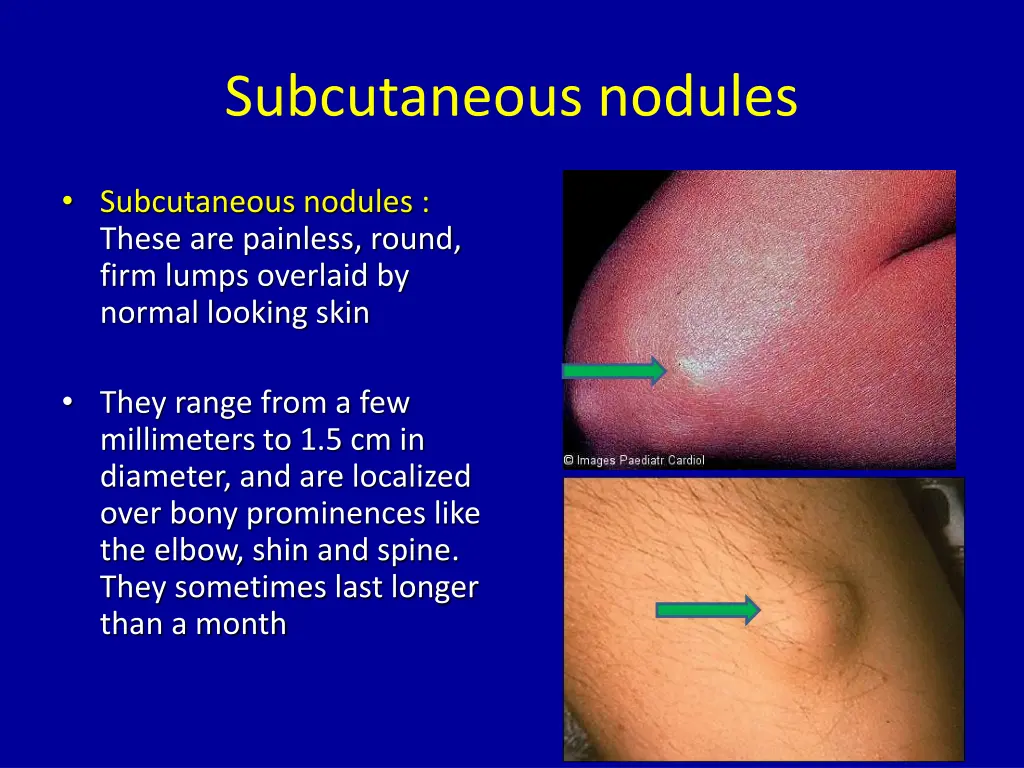 subcutaneous nodules