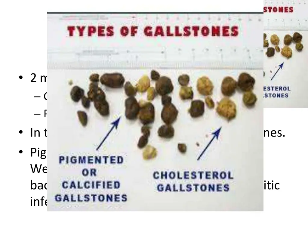 2 main types of gall stones cholesterol stones