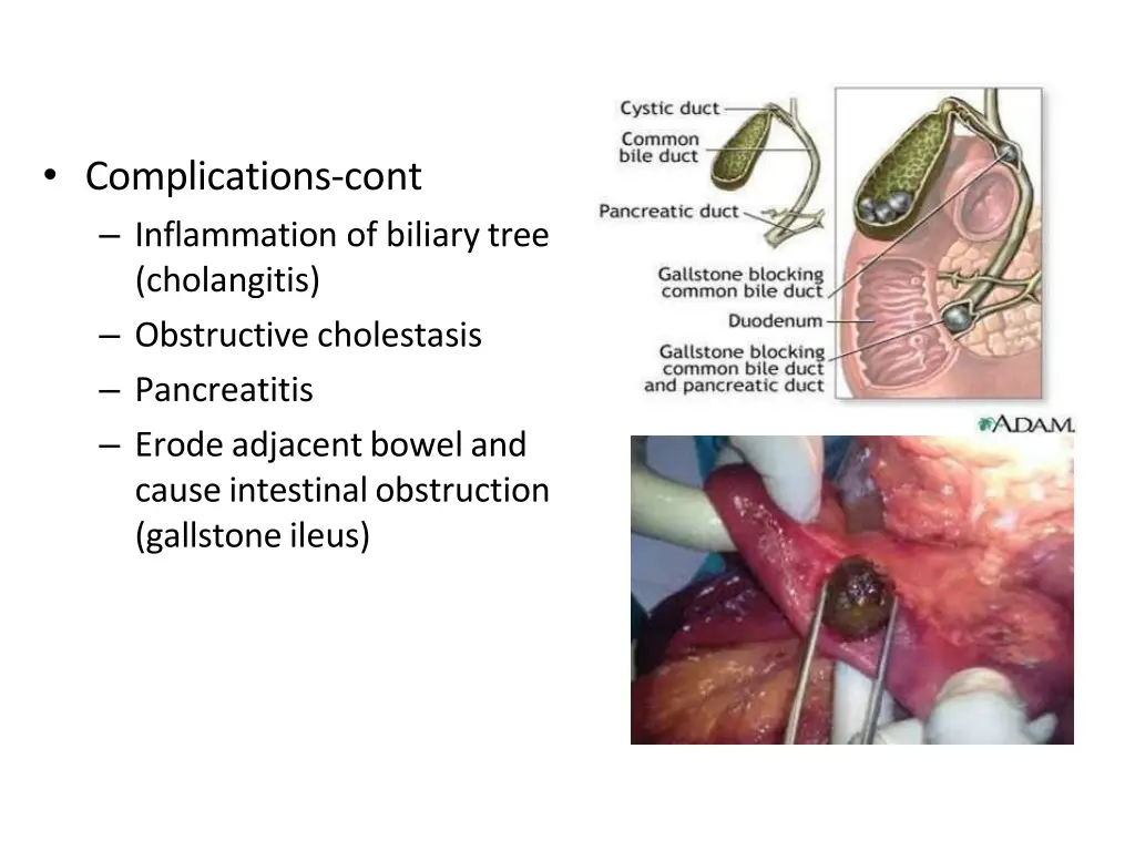 complications cont inflammation of biliary tree