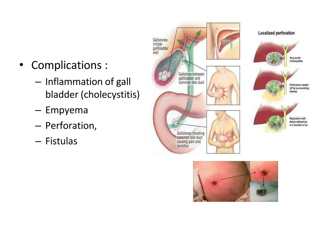 complications inflammation of gall bladder