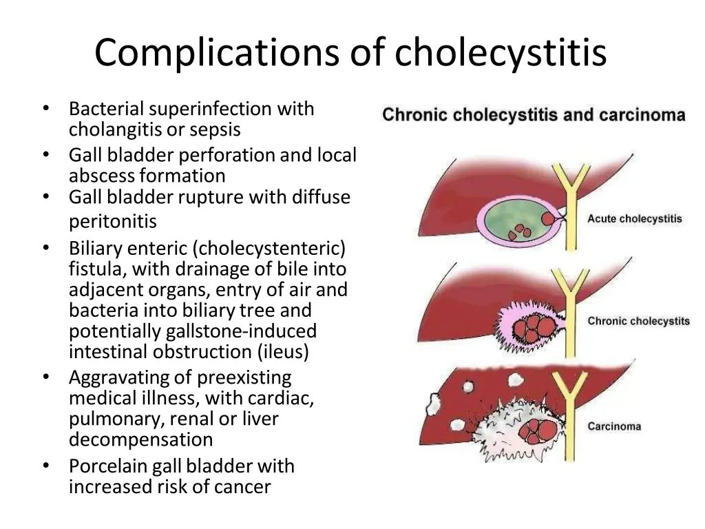 complications of cholecystitis