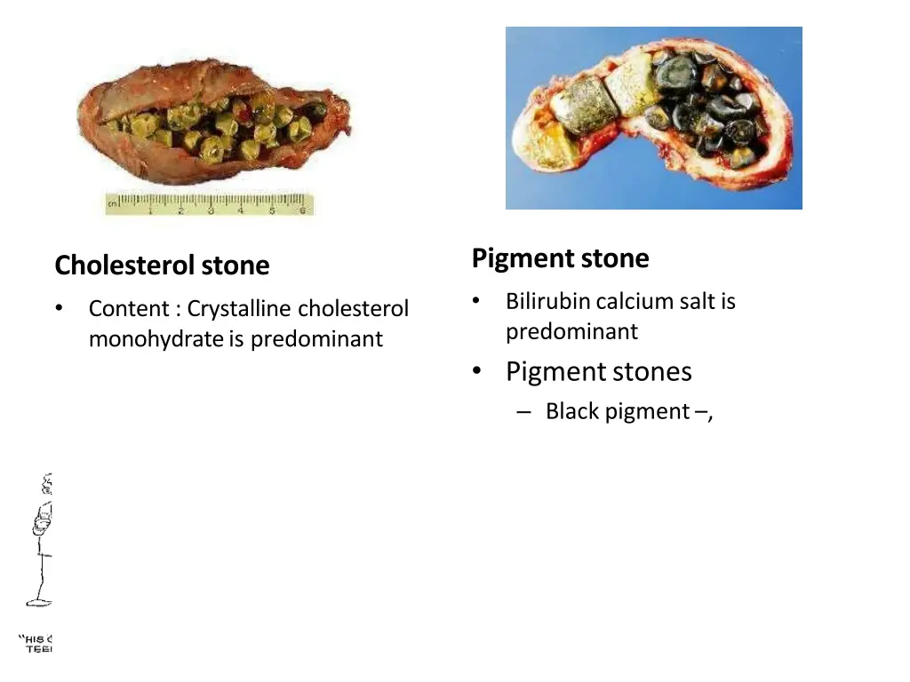 pigment stone bilirubin calcium salt
