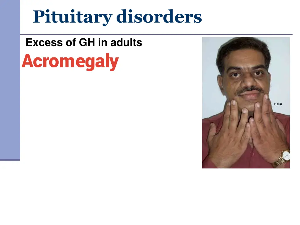 pituitary disorders 3