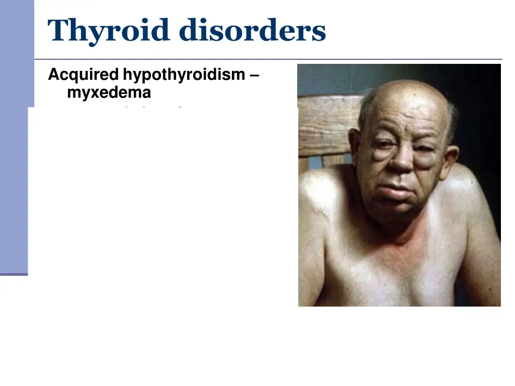 thyroid disorders 1