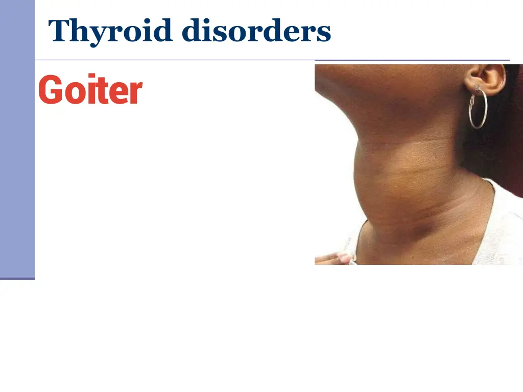 thyroid disorders goiter