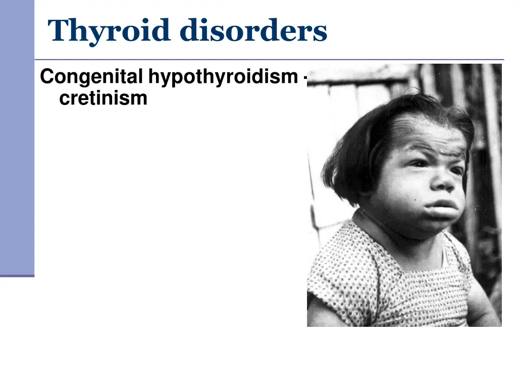 thyroid disorders