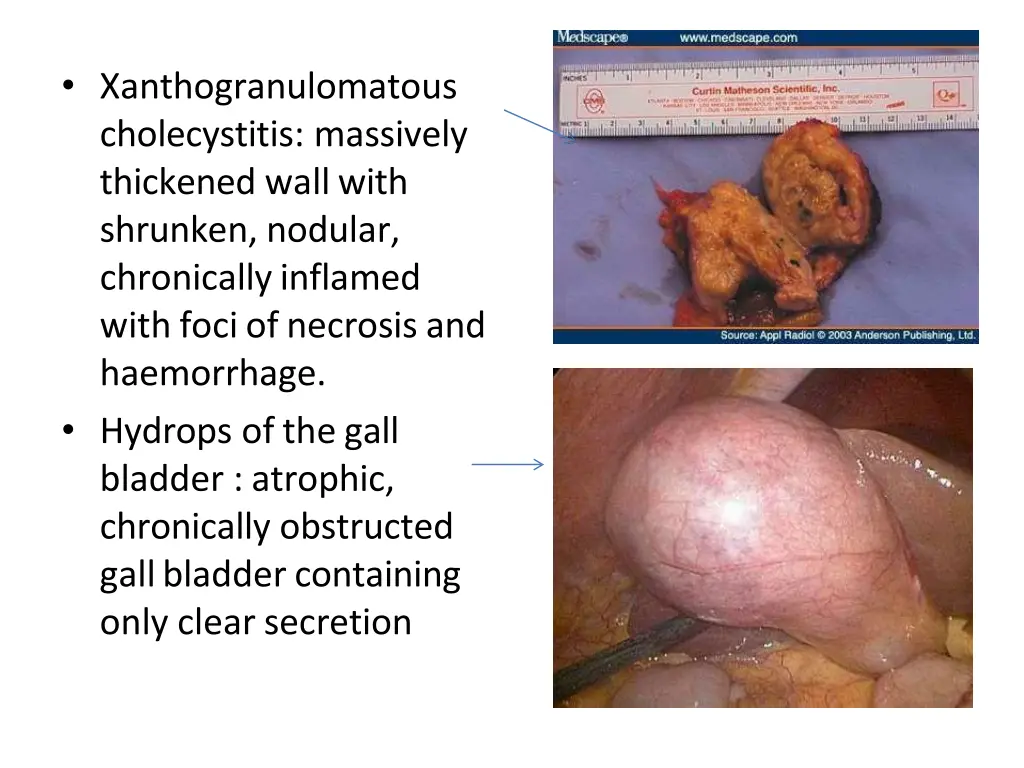 xanthogranulomatous cholecystitis massively
