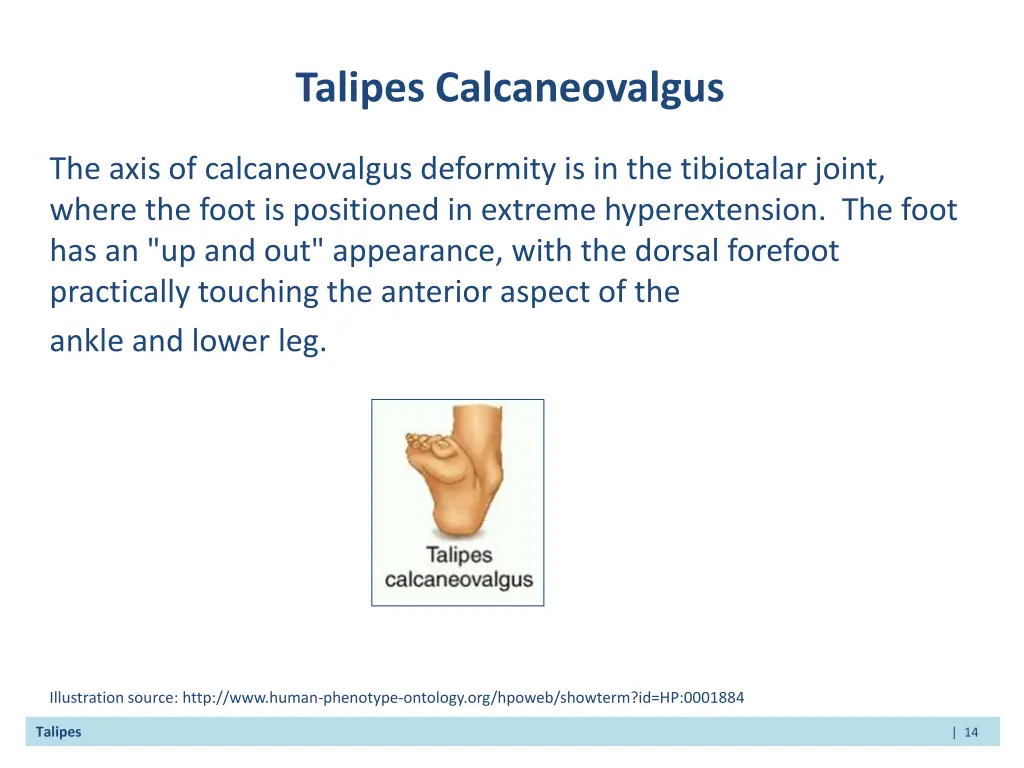 talipes calcaneovalgus
