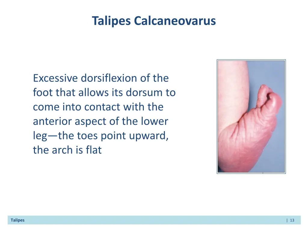 talipes calcaneovarus